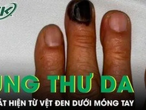Bàng hoàng phát hiện ung thư da từ vệt đen dưới móng tay