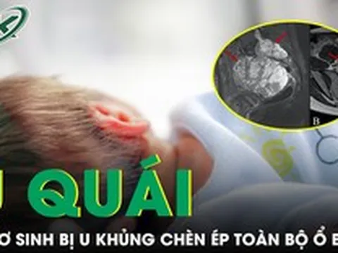 Cứu trẻ sơ sinh 10 ngày tuổi mang khối u hiếm gặp, chèn ép toàn bộ ổ bụng
