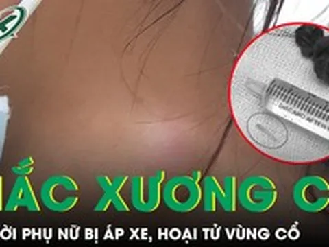 Xương cá nằm trong họng 5 tháng gây áp xe hoại tử vùng cổ