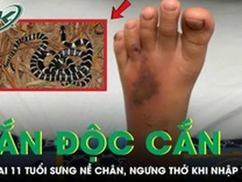 Bé trai 11 tuổi bị rắn độc cắn, sưng nề chân, ngưng thở khi nhập viện