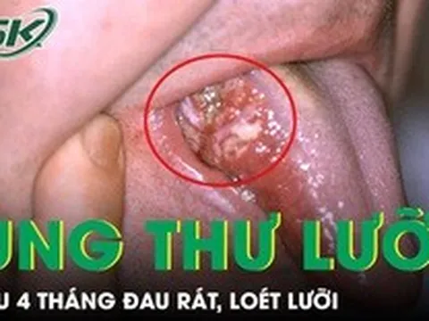 Loét lưỡi suốt 4 tháng, người đàn ông phát hiện ung thư ở tuổi 33