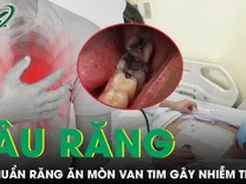 Hơn 10 chiếc răng sâu khiến người đàn ông 57 tuổi bị vi khuẩn ăn mòn van tim