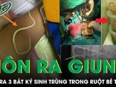 Bé trai 3 tuổi nôn ra giun, bác sĩ phẫu thuật lấy ra 3 bát ký sinh trùng trong ruột