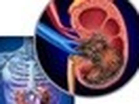 Người đàn ông bất ngờ phát hiện ung thư thận khi đi khám sức khỏe định kỳ: Tôi mới 32 tuổi, sao có thể...