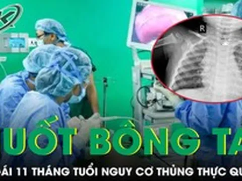 Nuốt phải bông tai kim loại, bé gái 11 tháng tuổi đối mặt nguy cơ thủng thực quản