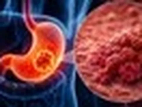 Bác sĩ cảnh báo: 1 THÓI QUEN trước khi ngủ đang âm thầm làm tăng nguy cơ ung thư dạ dày, nhiều người Việt vẫn làm hàng ngày