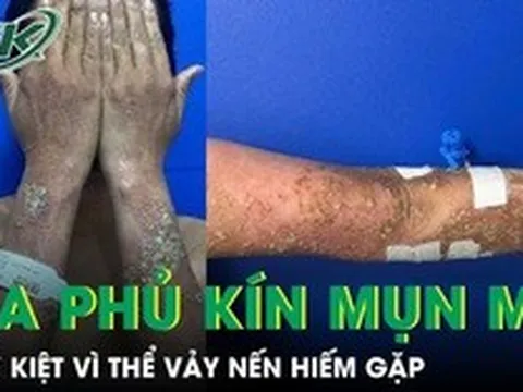 Da phủ kín mụn mủ, nữ bệnh nhân 28 tuổi suy kiệt vì thể vảy nến hiếm gặp