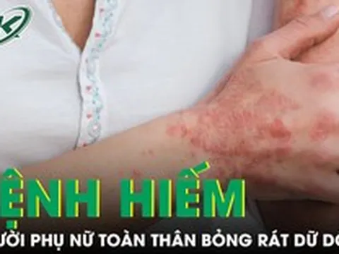 Căn bệnh hiếm khiến người phụ nữ sốt cao, toàn thân đỏ rực và bỏng rát dữ dội