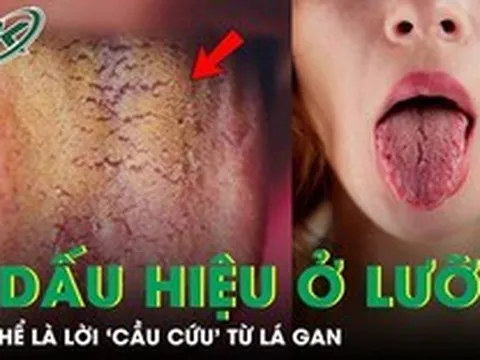 Đừng bỏ qua 3 dấu hiệu bất thường này trên lưỡi, có thể là lời 'cầu cứu' từ lá gan