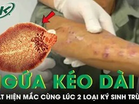 Người đàn ông tá hoả phát hiện mắc cùng lúc hai loại ký sinh trùng từ dấu hiệu ngứa kéo dài