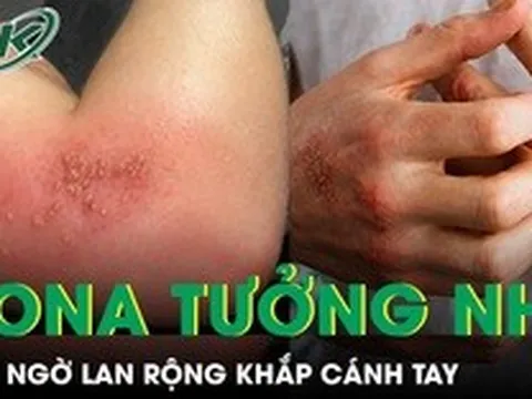 Zona tưởng nhẹ bất ngờ lan rộng khắp cánh tay khiến du khách trẻ nhập viện