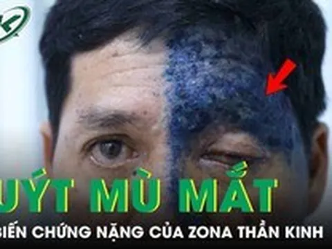Người đàn ông 54 tuổi suýt mù mắt do biến chứng nặng của zona thần kinh