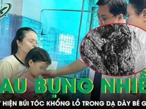 Đau bụng nhiều ngày, bé gái 4 tuổi bất ngờ được bác sĩ lấy ra khỏi dạ dày búi tóc khổng lồ