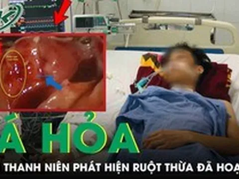 Tưởng bị rối loạn tiêu hóa, nam thanh niên 23 tuổi tá hỏa phát hiện ruột thừa đã hoại tử