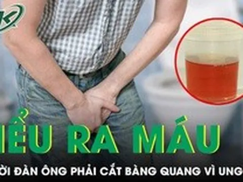 Chủ quan tiểu ra máu nhiều năm, người đàn ông phải cắt bàng quang vì ung thư