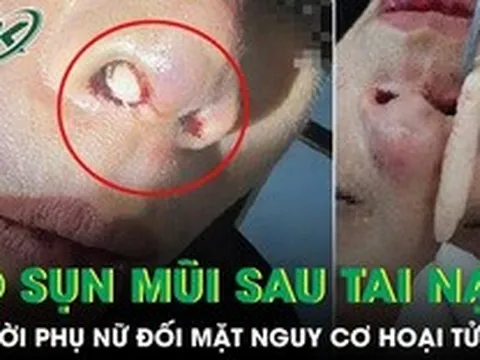 Nâng mũi xong gặp tai nạn, người phụ nữ đối mặt nguy cơ hoại tử mũi