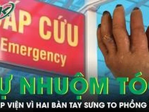 Tự nhuộm tóc tại nhà người đàn ông nhập viện vì hai bàn tay sưng to phồng rộp